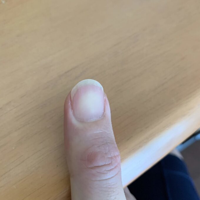 折れた爪をしているクラシックギター弾きの爪の形　その2