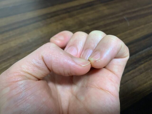 あかぎれが起きたクラシックギタリストの左手